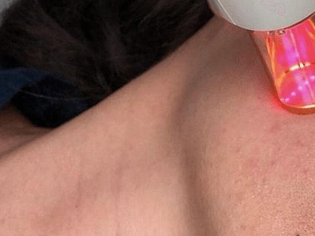 Laser Resurfix de Lumenis