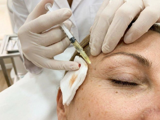 Recupera una mirada descansada: tratamiento de ojeras con ácido hialurónico en Vigo - Imagen 1